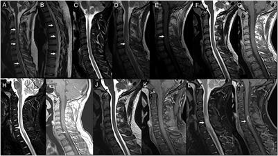 CNS inflammatory demyelinating events after COVID-19 vaccines: A case series and systematic review